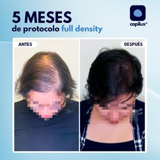 CON ESTE TRATAMIENTO TU PELO ESTARÁ MÁS GRUESO Y CON UNA MAYOR DENSIDAD💪🏼 ...

Con el protocolo fu