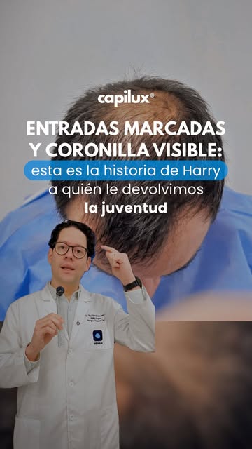 EL RESULTADO DEFINITIVO A UN AÑO DE SU IMPLANTE CAPILAR: DENSIDAD REAL, NATURALIDAD Y SIN INSEGURIDA