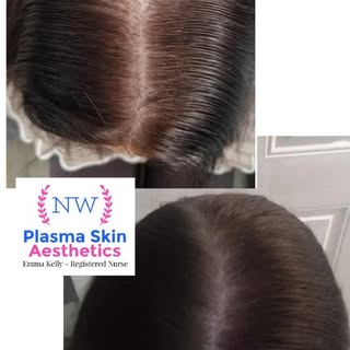 🔥The real results are in...4 weeks into my lovely clients Derma hair growth treatment programme🔥
�