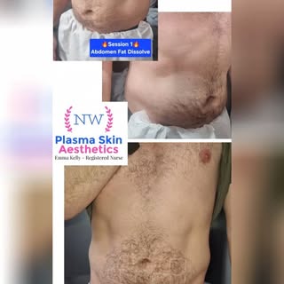 🔥 Fat dissolve treatment results 4 weeks post treatment - 1st session 
checkout those results alrea