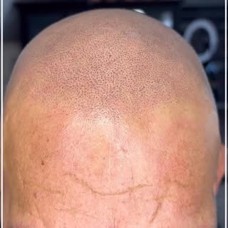 Scalp Micropigmentation, work in progress…..

Let’s zoom in and out……

No filters, just a ring light