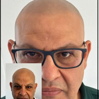 SMP has two benefits. 

It camouflages your unwanted baldness and gives you a younger appearance 🙌
