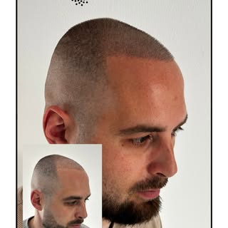 Scalp Micropigmentation is not only a solution for people suffering from partial or complete baldnes
