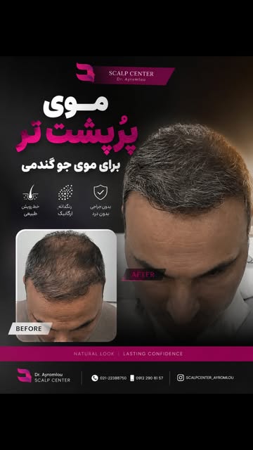 کم‌پشتی همیشه به معنی طاسی نیست.
گاهی موها وجود دارن، اما تراکم بصری کافی ندارن و پوست سر بیشتر از چ