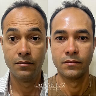 ✨ Resultado de Rejuvenescimento ✨
Hoje compartilho o antes e depois de um cliente que buscava um olh