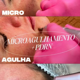 ✨ Pele renovada de dentro para fora!

O microagulhamento associado ao PDRN é um protocolo que estimu