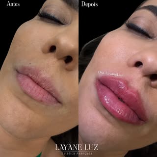 “Eu sempre quis fazer preenchimento labial, mas tinha medo de ficar com a boca grande, artificial e 