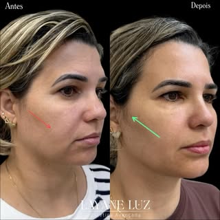 Colágeno não muda apenas a pele. Ele devolve a estrutura que o tempo vai levando. 🤍✨

Esse resultad