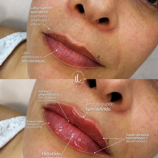 Lábios bonitos não chamam atenção pelo volume, mas pela harmonia.

O preenchimento labial é um proce