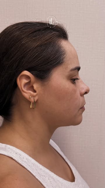 Nem todo rosto precisa de mais volume. Uma harmonização facial bem planejada começa entendendo o que
