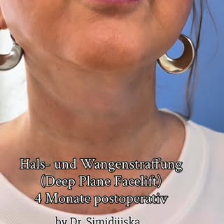 💫 Ergebnis 4 Monate nach Hals- und Wangenstraffung (Deep Plane Facelift). Zu dieser Zeit sind die N