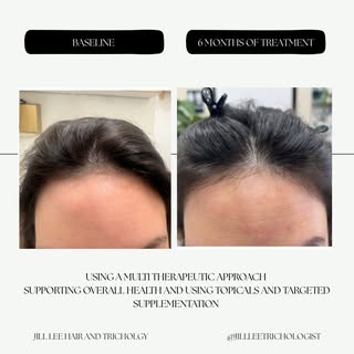 6 month results! 

This client was very motivated and therefore consistent in implementing the treat