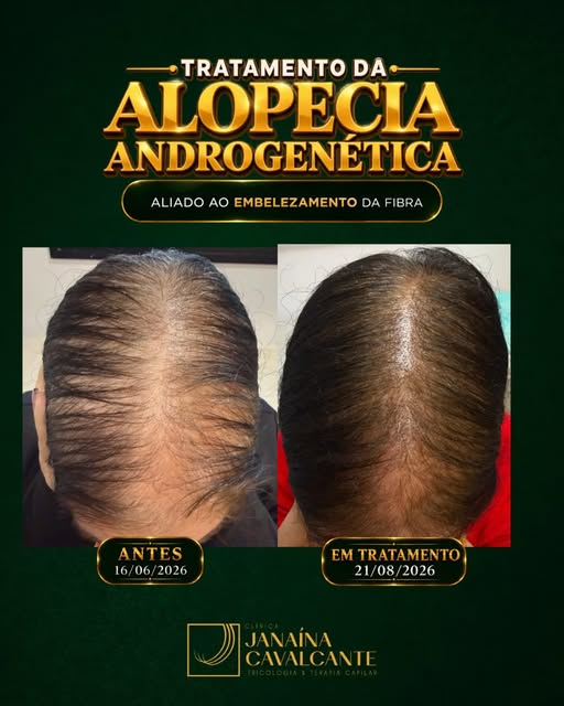 Neste caso, estamos acompanhando uma paciente com alopecia androgenética feminina em estágio mais av