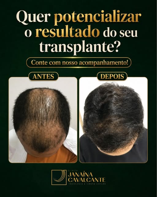 O transplante capilar é um grande passo, mas o cuidado não termina após o procedimento. O acompanham