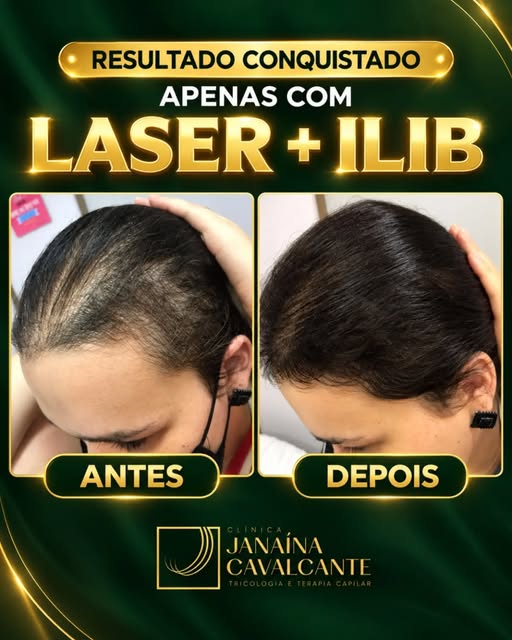 Neste caso, o resultado foi conquistado apenas com laserterapia capilar e ILIB, aplicados de forma e