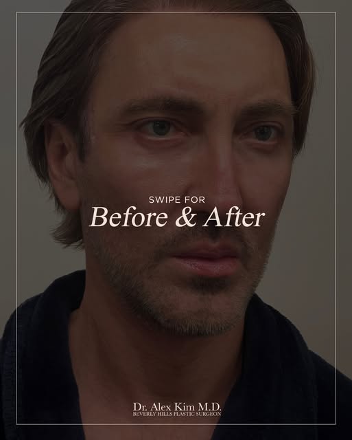 Before and After photos of a recent Facelift. The goal was a subtle but appreciable, natural appeari