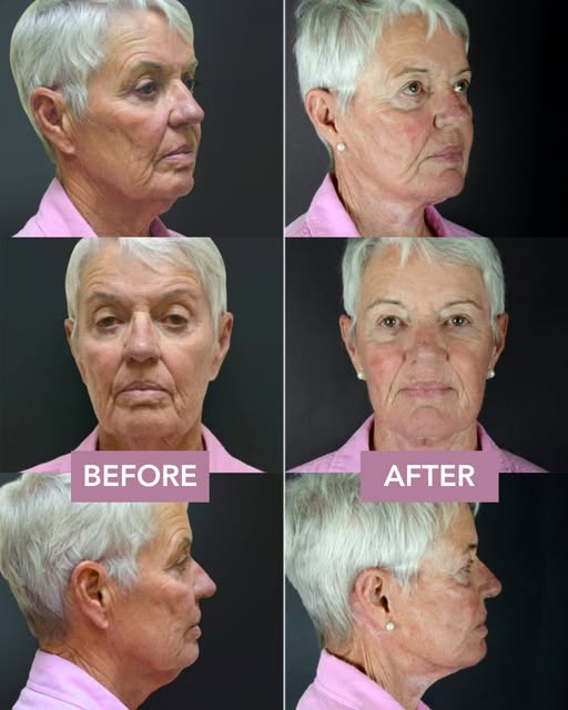 The facelift Dr. Sobel performs is a structural re-elevation. Using the deep-plane technique, he lif