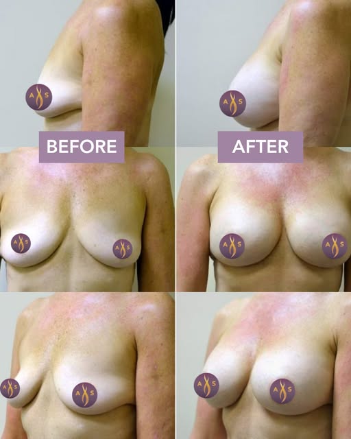Breast augmentation later in life sits differently than one done at 30. The goal is often to restore