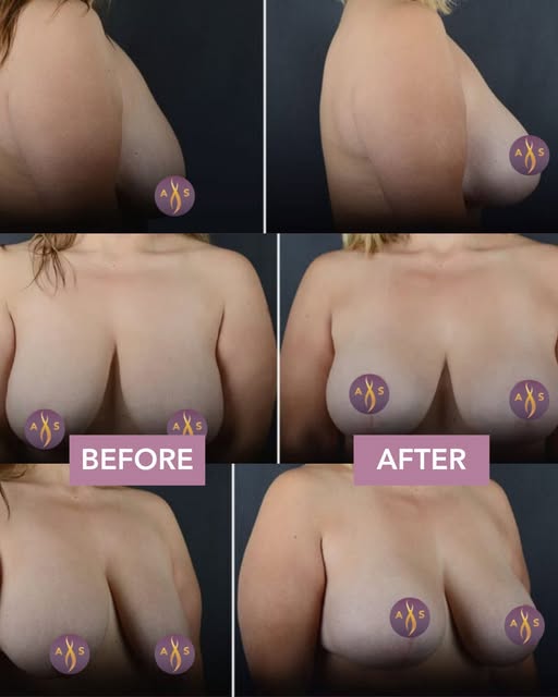 A breast lift with augmentation is the combined procedure Dr. Sobel most often recommends when the p