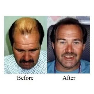 Tired of dealing with a receding hairline? Our personalized and high-quality hair transplantation pr