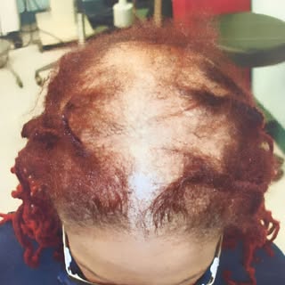 By the age of 35, 2/3 of men start experiencing hair loss? Don't worry, our expert team is here to h