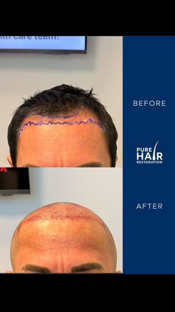 A new hairline can completely change the way your face is framed.

For this patient, we focused on r