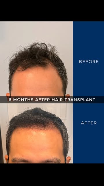Six months of growth and already a noticeable difference. 👏

This patient’s hair transplant focused