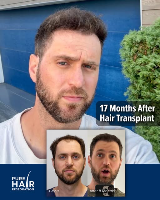 Can you believe @halfcubandave ’s hairline?!👀 All we can say is GOALS🏆

He is 17 months post op fr