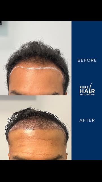 A restored hairline, immediately after transplant. ✨

For this patient, we focused on rebuilding the