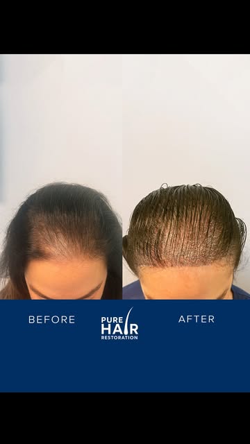 Female hair loss can significantly change the appearance of the hairline and overall density, but ha