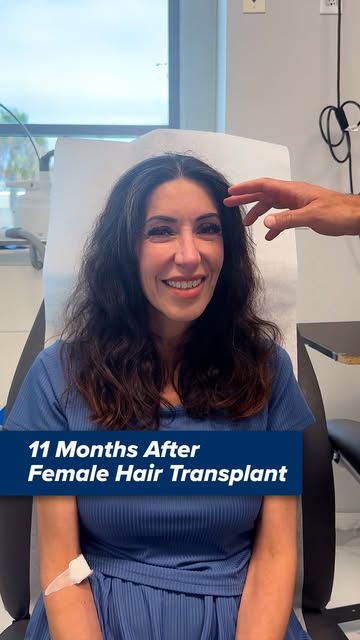 11 Months After Her Hair Transplant ✨

After a previous brow lift left a visible scar along her hair
