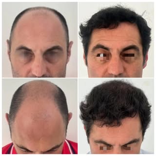 Alopecia androgénica grado VI. Control de 1 año.
Equipo: @dr.jwong @ricardo_aleman_cervantes @tecnic
