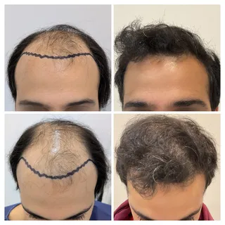 Reconstrucción frontal. Control de 1 año.
Equipo: @krupsvillena.capilar @barbarairungaraycapilar 

@