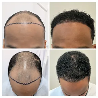 Pelo AFRO 🔥🔥
Reconstrucción frontal + densificación de coronilla + cobertura de cicatrices.

Equip