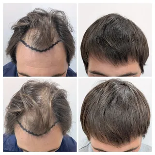 Reconstrucción frontal + densidad de coronilla. Control de 8 meses.

Equipo: @dr.jwong @krupsvillena