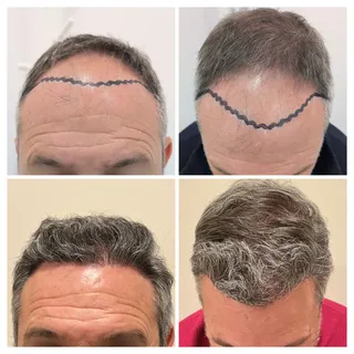 Control 12 meses. Reconstrucción frontal y densidad en coronilla.

Equipo: @dr.jwong @krupsvillena.c