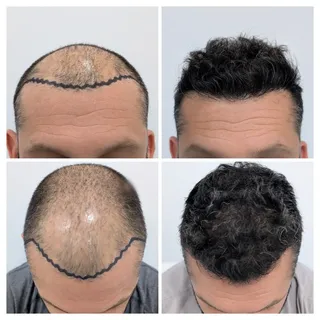 Control 7 meses. Reconstrucción frontal. 
Equipo: @dr.jwong @krupsvillena.capilar @barbarairungarayc