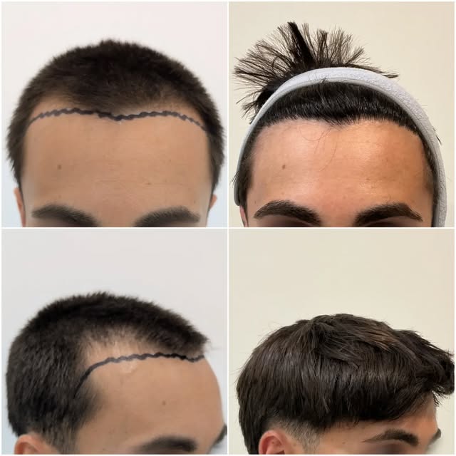 Reconstrucción frontal. Control 9 meses. 
Equipo: @dr.jwong @krupsvillena.capilar @barbarairungarayc