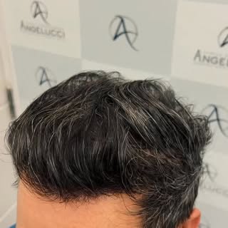 Resultado Transplante Capilar após 1 ano. O objetivo é sempre muita naturalidade e a máxima densidad