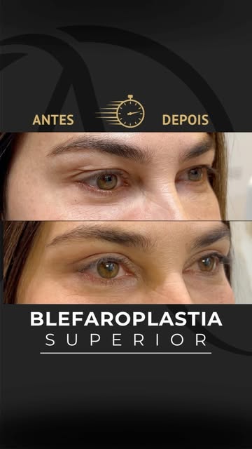 👁️ Resultado de Blefaroplastia Superior
após 1 mês.

• Beneficios:
🔹Remoção de gordura.
🔹Remoção 