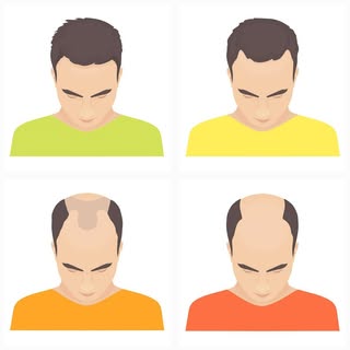 Male pattern baldness, also called androgenic alopecia, is the most common type of hair loss in men.