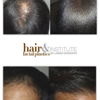 Learn about the options to help with your hair loss.  Visit www.forhairhelp.com.

#hairandfacialplas