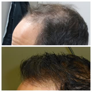 Learn about the options to help with your hair loss. Visit www.forhairhelp.com.
#hairandfacialplasti