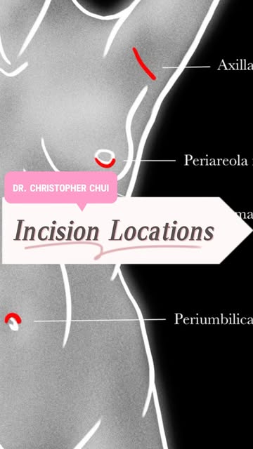 Where are breast implants inserted? Dr Christopher Chui explains the three most common breast implan