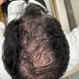 Resultado incrível! 🤩 Confira a evolução deste paciente após tratamento clínico combinado com Micro