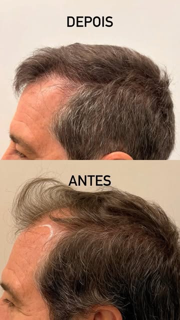 O resultado de um transplante capilar não acontece de um dia para o outro.

O antes e depois que voc