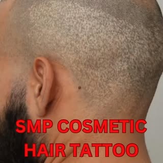 Hair transplant scar + hair loss 💉

This client came to us with concerns about hair loss, as well a