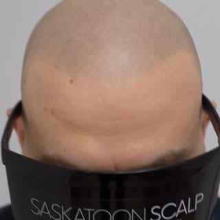Not hair.. just a cosmetic hair tattoo 💉 

SASKATOON SCALP
In the business of changing lives 🙌

SM