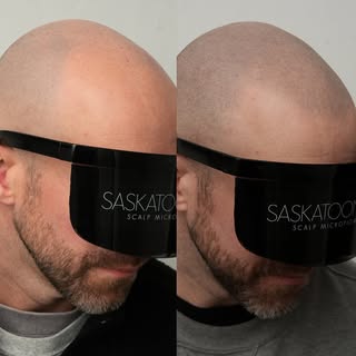 Before VS Healed SMP 💉

SASKATOON SCALP
In the business of changing lives 🙌

SMP is a revolutionar