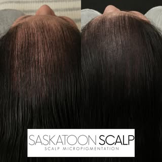 Scalp micropigmentation SMP for hair thinning 💉

SASKATOON SCALP
In the business of changing lives 